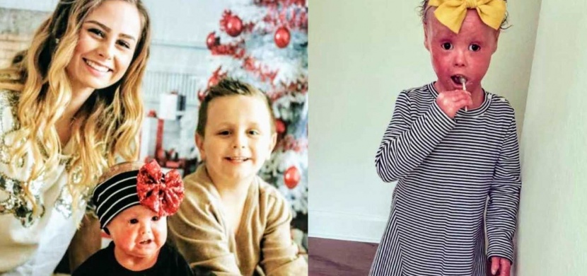 Čtyřletá Harper Foy se narodila s harlekýnovou ichtyózou. V rámci osvěty svého onemocnění se stala dětskou modelkou