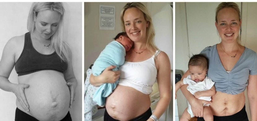 Jak vypadá ženské tělo po porodu: Novozélandská maminka ukázala, že se není za co stydět