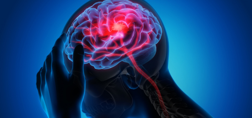 Cévní mozková příhoda: Zhoubná nemoc, která postihuje zejména ženy