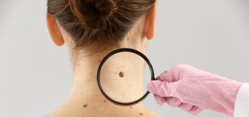 5 příznaků, které dokážou včas odhalit rakovinu kůže