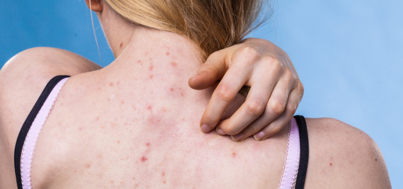 Trápí vás akné na zádech nebo v dekoltu? Může za to častá chyba při sprchování